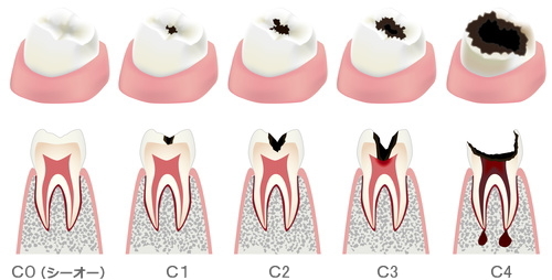 いわい歯科医院のむし歯の治療