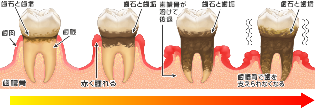 歯周病治療