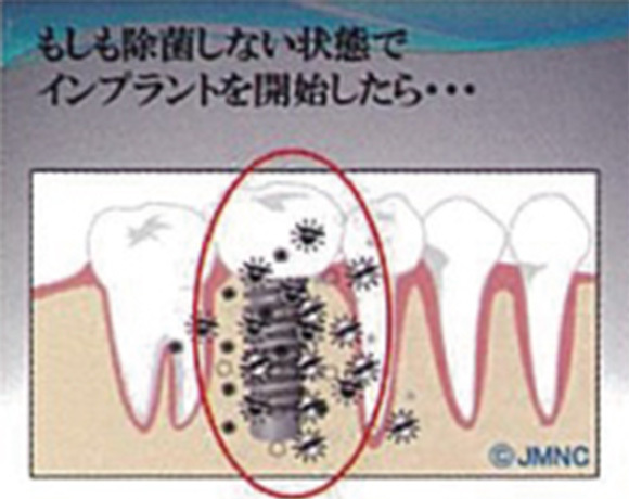 インプラント治療を受けられる方