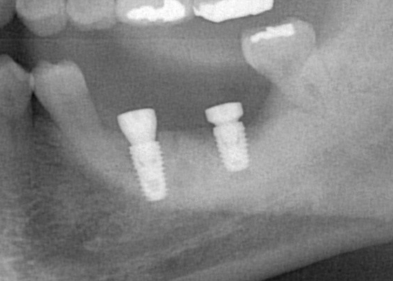 インプラント埋入後