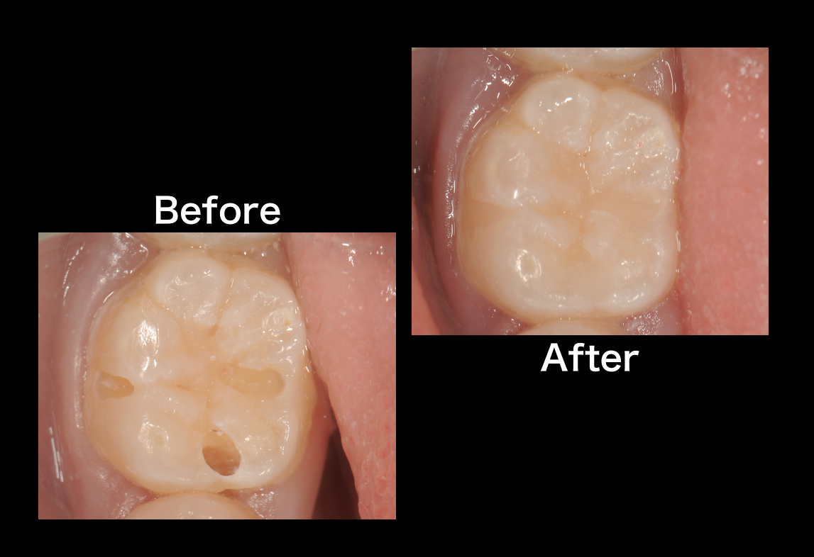 コンポジットレジンと呼ばれる樹脂を使用した詰めもの