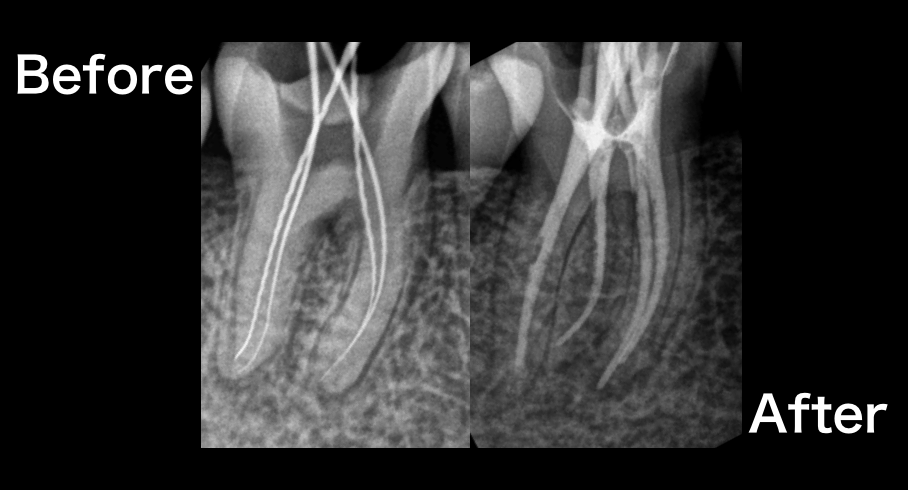 歯内根管治療