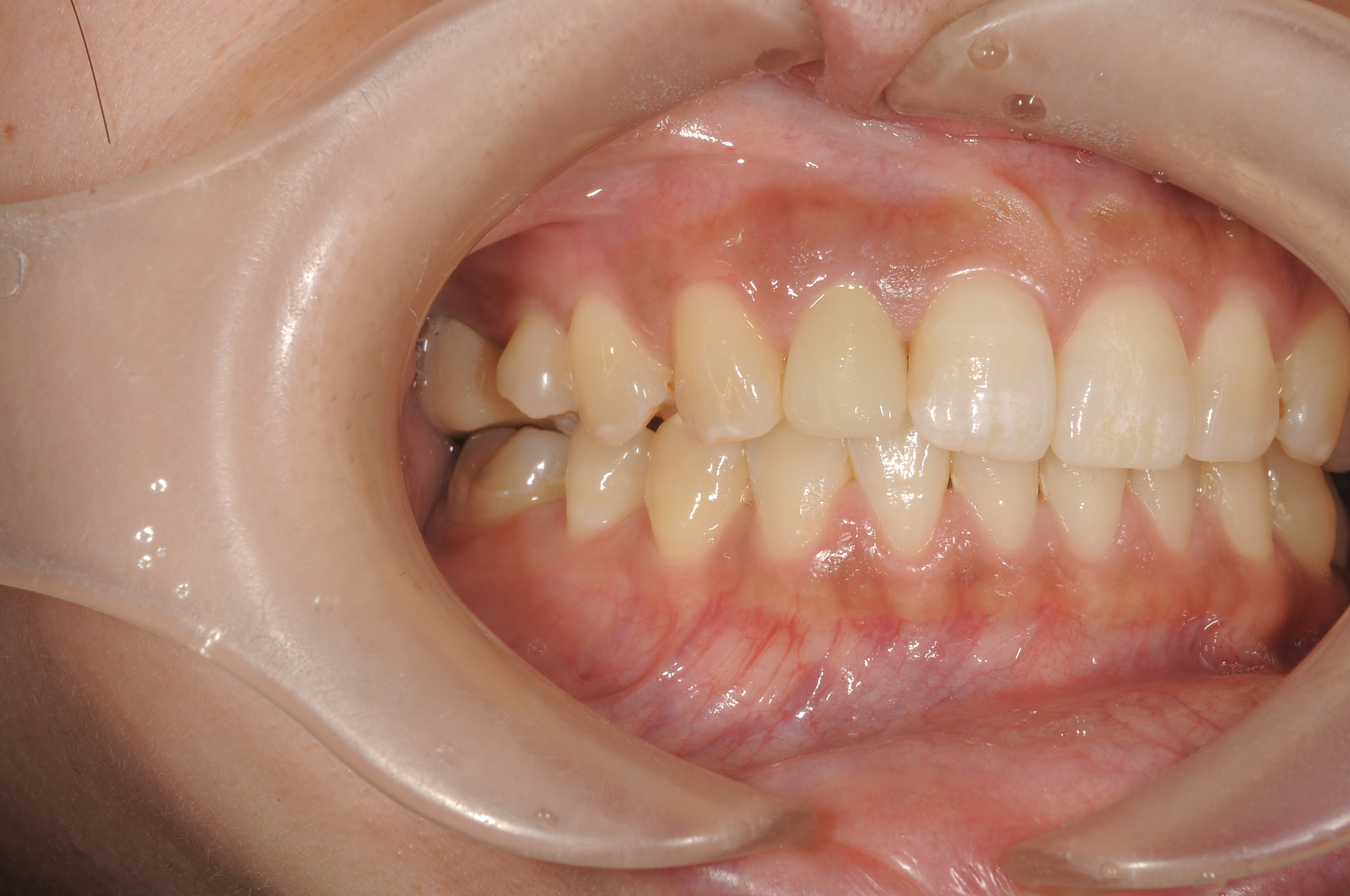 どの歯がエステティッククラウンかわかりますか？