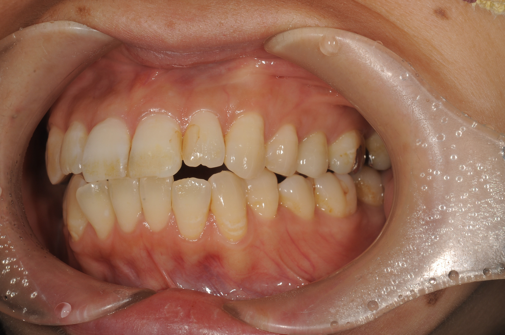 どの歯がエステティッククラウンかわかりますか？
