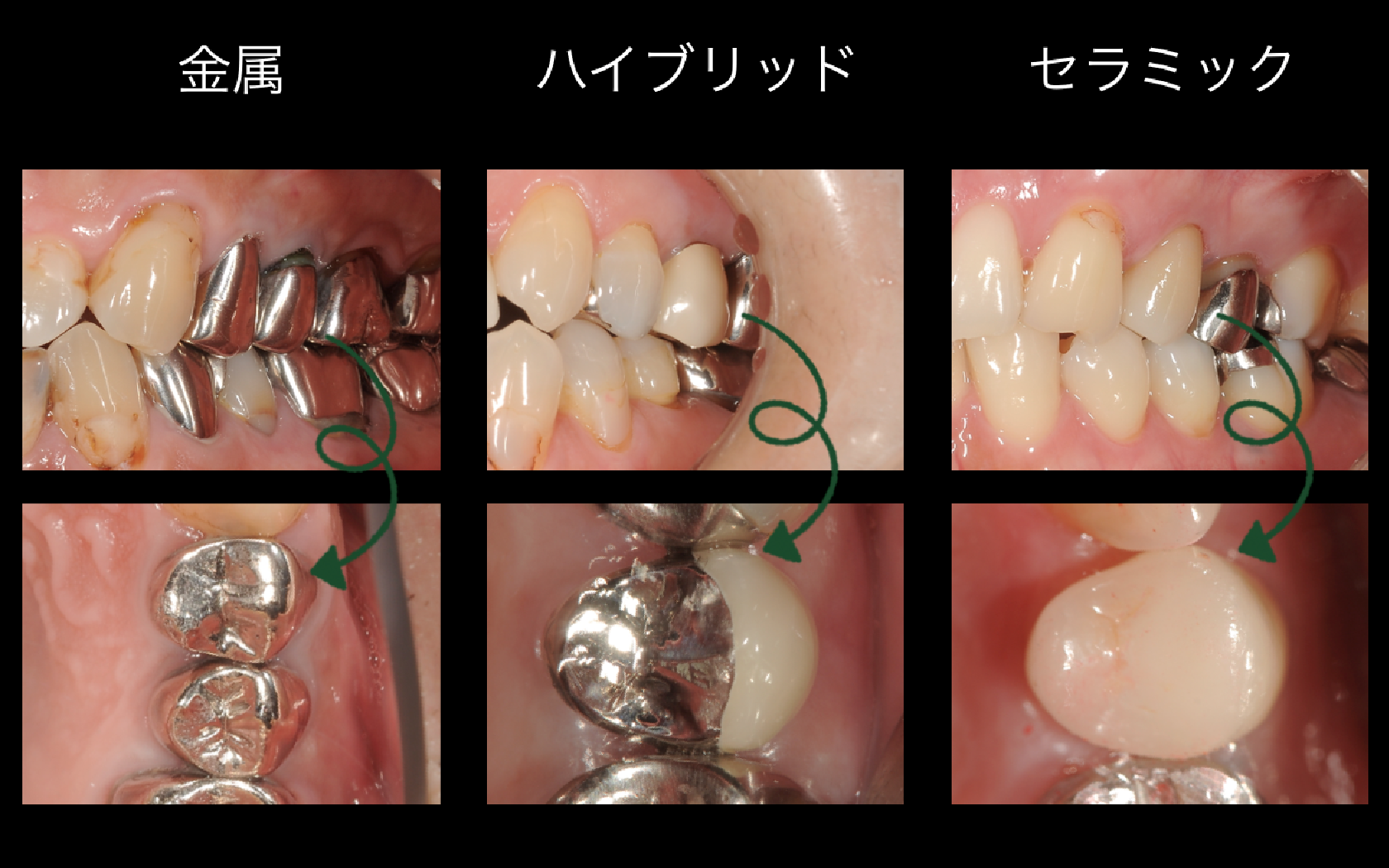 "白いかぶせもの"といってもさまざまな白色があります。