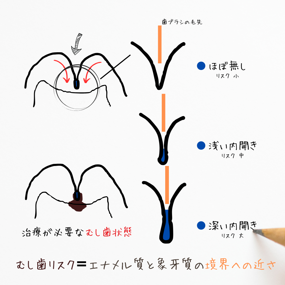 歯の溝のリスクと予防について