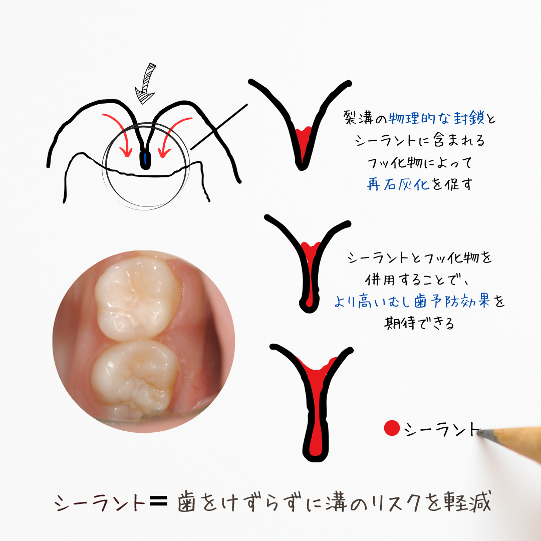 歯の溝のリスクと予防について